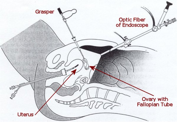 Laparoscopia